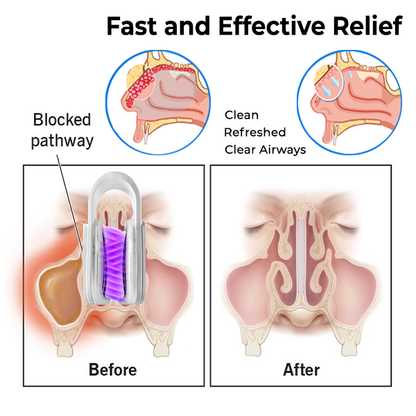 BreathEase Nasal Unblocking Device