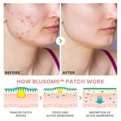 Blusoms™ Pro AcneAtelier Microneedles Patch